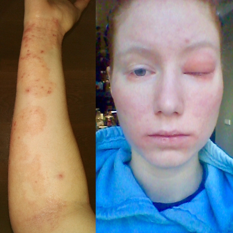 Heilpraktikerin Lisa Ophardt hat Neurodermitis Hautausschlag auf ihrer Haut