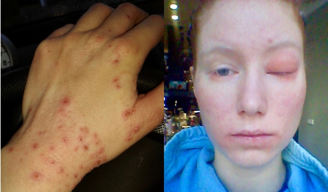 Heilpraktikerin Lisa Ophardt hat Neurodermitis Hautausschlag auf ihrer Haut